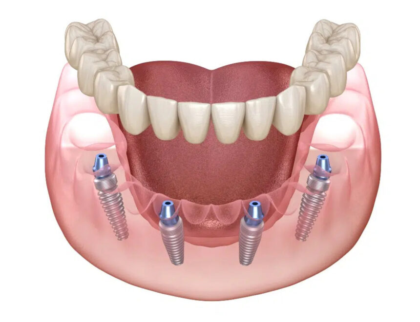 Dantų atkūrimas „All on 4” technika: kas tai ir kiek kainuoja?